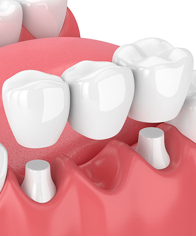 Dental Bridges | Family Dental Centre | General and Family Dentist | SE Calgary