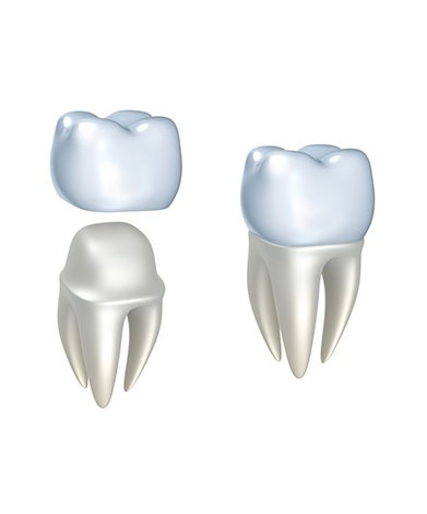 Dental Crowns | Family Dental Centre | General and Family Dentist | SE Calgary