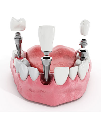 Dental Implants | Family Dental Centre | General and Family Dentist | SE Calgary
